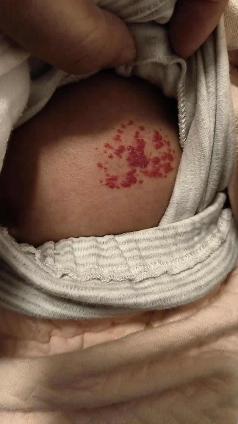 新生儿血管瘤生长速度过快怎么办?家长该如何应对与护理?-第1张图片-郑州医学网 新生儿血管瘤生长速度过快怎么办?家长该如何应对与护理?-第1张图片-郑州医学网