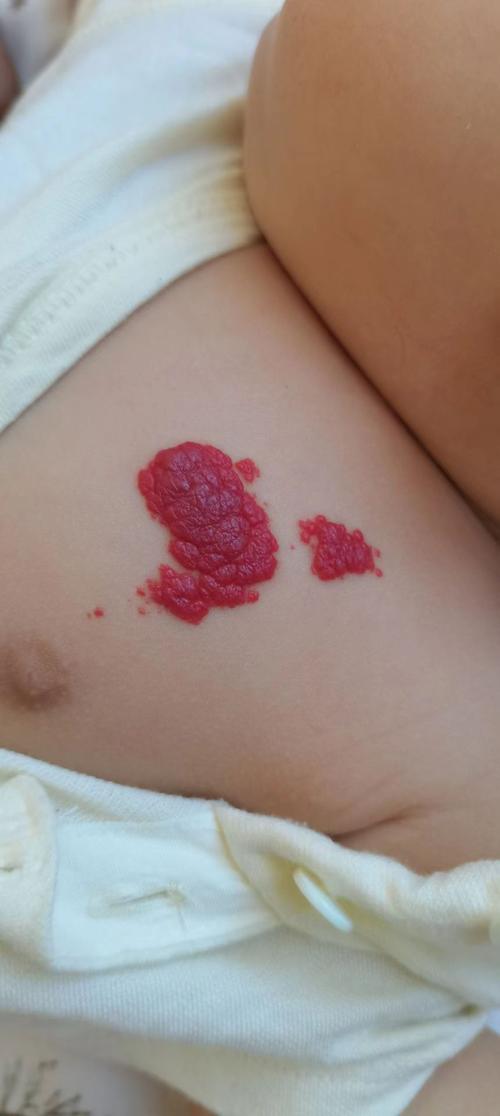 新生儿血管瘤生长速度过快怎么办?家长该如何应对与护理?-第3张图片-郑州医学网 新生儿血管瘤生长速度过快怎么办?家长该如何应对与护理?-第3张图片-郑州医学网