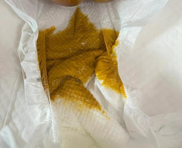 新生儿大便黏糊糊的，是消化不良还是正常现象？-第2张图片-郑州医学网