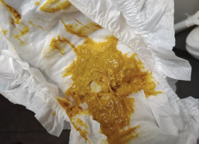 新生儿大便黏糊糊的，是消化不良还是正常现象？-第3张图片-郑州医学网