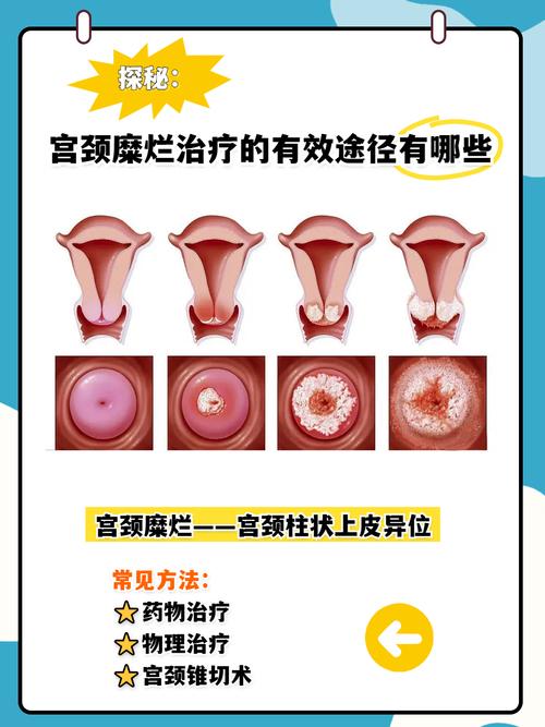 怀孕期宫颈糜烂影响胎儿健康吗？该如何安全治疗与护理？-第1张图片-郑州医学网