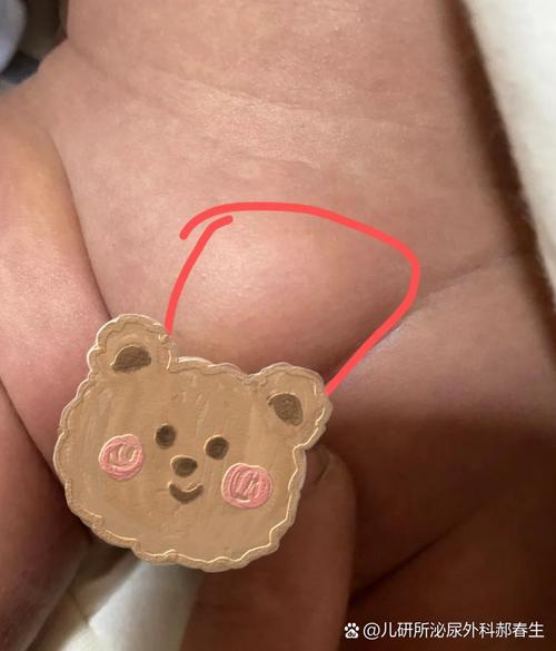 新生儿屁眼有个肉疙瘩是什么?需要担心吗?该怎么处理?-第1张图片-郑州医学网 新生儿屁眼有个肉疙瘩是什么?需要担心吗?该怎么处理?-第1张图片-郑州医学网