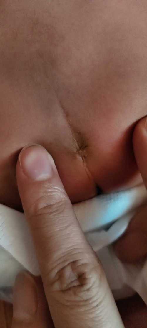 新生儿屁眼有个肉疙瘩是什么?需要担心吗?该怎么处理?-第2张图片-郑州医学网 新生儿屁眼有个肉疙瘩是什么?需要担心吗?该怎么处理?-第2张图片-郑州医学网