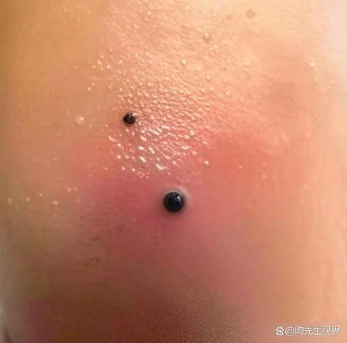 新生儿屁眼有个肉疙瘩是什么?需要担心吗?该怎么处理?-第3张图片-郑州医学网 新生儿屁眼有个肉疙瘩是什么?需要担心吗?该怎么处理?-第3张图片-郑州医学网