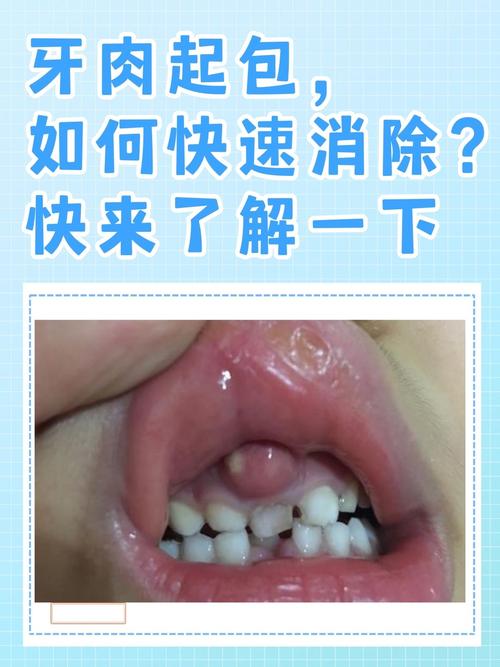 儿童牙龈长肉疙瘩是上火还是病变？需要治疗吗？-第1张图片-郑州医学网