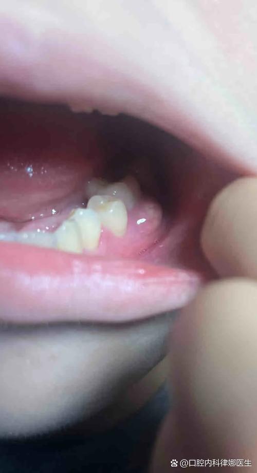 儿童牙龈长肉疙瘩是上火还是病变？需要治疗吗？-第2张图片-郑州医学网