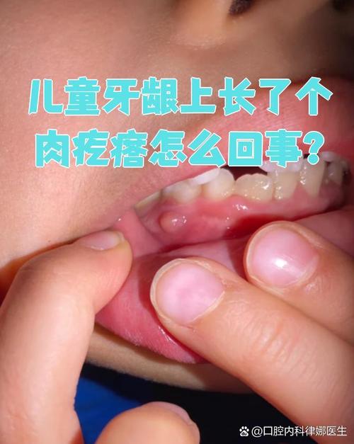 儿童牙龈长肉疙瘩是上火还是病变？需要治疗吗？-第3张图片-郑州医学网