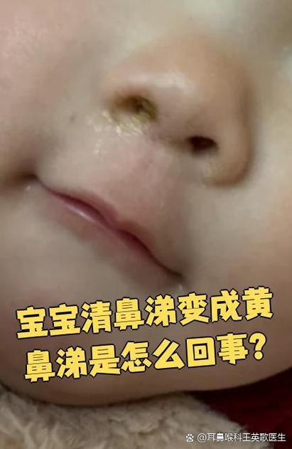 新生儿鼻子里有黄泡泡是正常现象还是生病信号?需要家长注意处理吗?-第2张图片-郑州医学网 新生儿鼻子里有黄泡泡是正常现象还是生病信号?需要家长注意处理吗?-第2张图片-郑州医学网