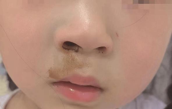 新生儿鼻子里有黄泡泡是正常现象还是生病信号?需要家长注意处理吗?-第1张图片-郑州医学网 新生儿鼻子里有黄泡泡是正常现象还是生病信号?需要家长注意处理吗?-第1张图片-郑州医学网