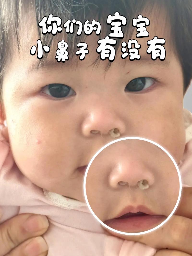 新生儿鼻子里有黄泡泡是正常现象还是生病信号?需要家长注意处理吗?-第3张图片-郑州医学网 新生儿鼻子里有黄泡泡是正常现象还是生病信号?需要家长注意处理吗?-第3张图片-郑州医学网