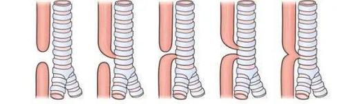 新生儿食道闭锁术后会面临哪些长期健康挑战与生活质量影响？-第2张图片-郑州医学网