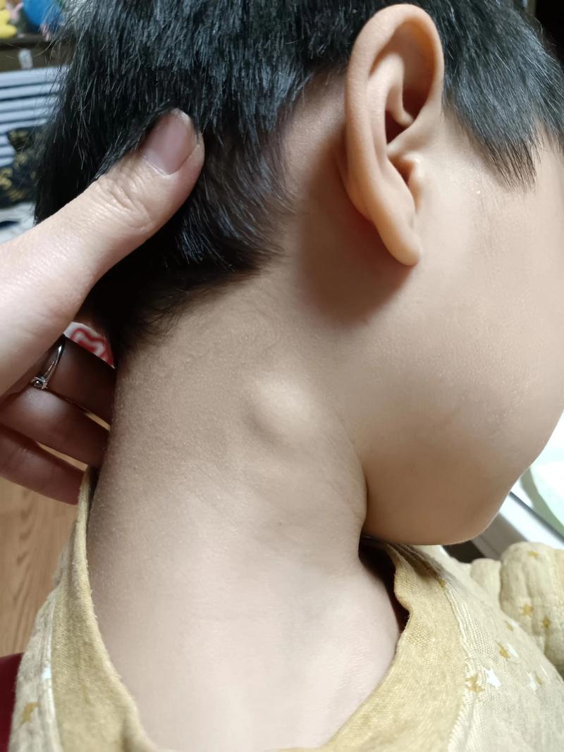 儿童淋巴结发炎伴随肚子疼，是感染扩散还是其他疾病信号？-第3张图片-郑州医学网