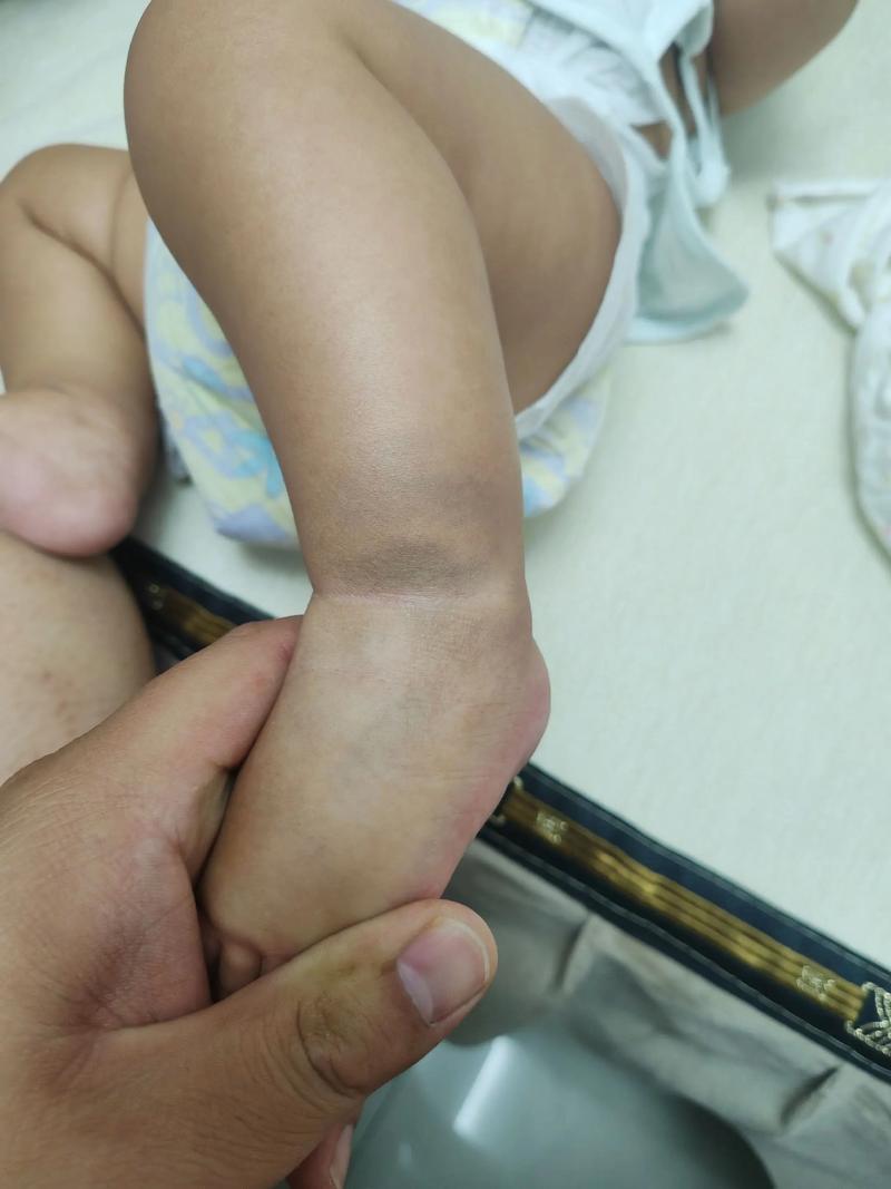 新生儿手上青斑会自行消退吗？需要干预治疗吗？-第1张图片-郑州医学网