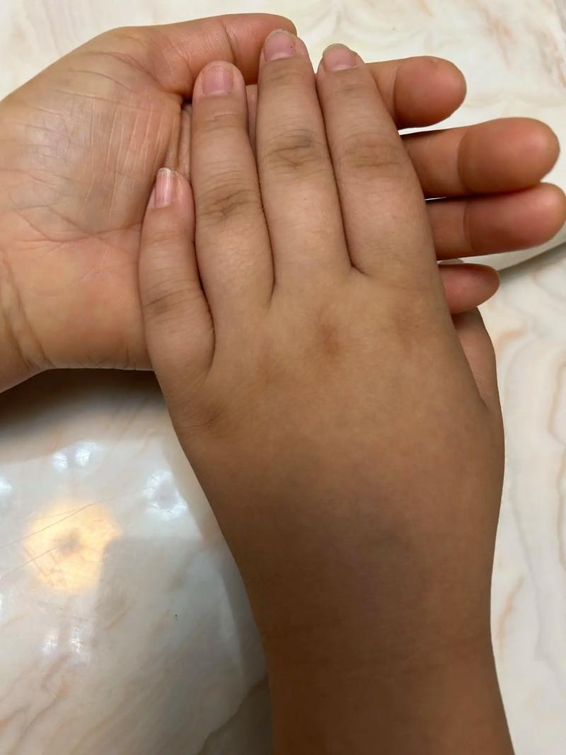 新生儿手上青斑会自行消退吗？需要干预治疗吗？-第2张图片-郑州医学网