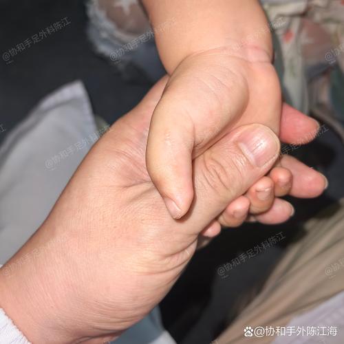 新生儿手上青斑会自行消退吗？需要干预治疗吗？-第3张图片-郑州医学网