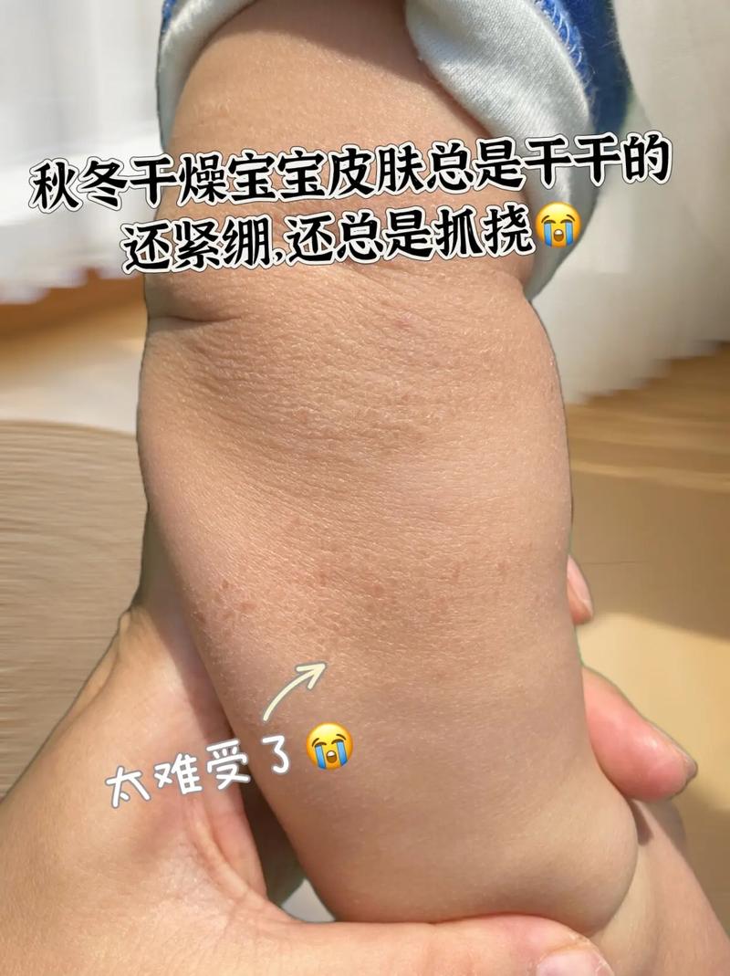 儿童皮肤干燥痒，日常护理和用药该怎么选才安全有效？-第2张图片-郑州医学网