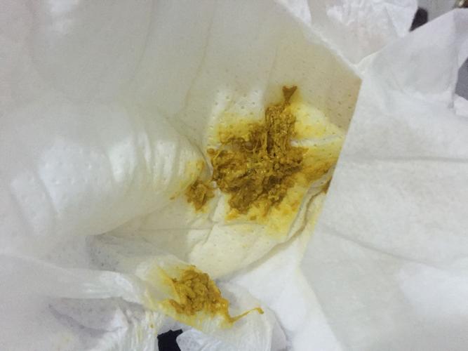 新生儿大便突然喷黄水带屎，是消化不良还是感染了？-第1张图片-郑州医学网