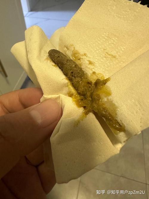 新生儿大便突然喷黄水带屎，是消化不良还是感染了？-第2张图片-郑州医学网