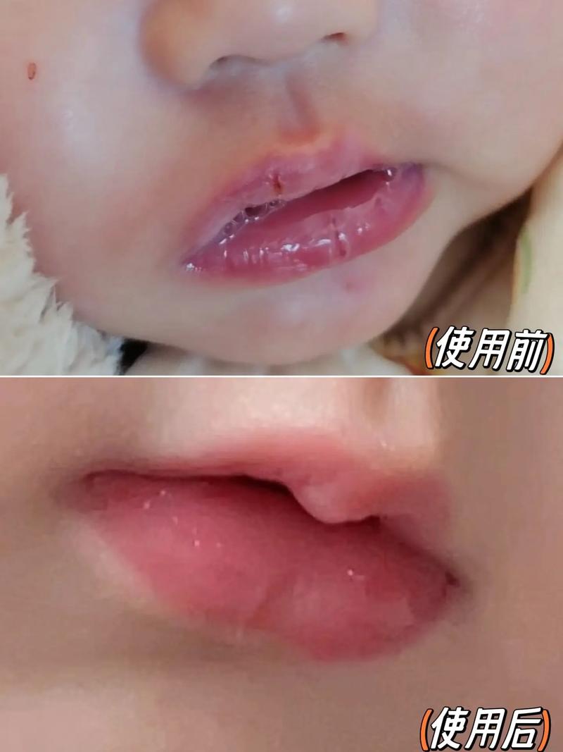 新生儿嘴唇脱皮是缺水还是疾病？日常护理该注意什么？-第1张图片-郑州医学网