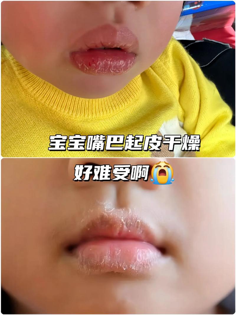 新生儿嘴唇脱皮是缺水还是疾病？日常护理该注意什么？-第2张图片-郑州医学网