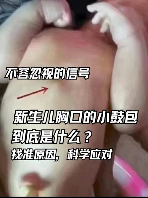 新生儿胆管细窄有哪些典型表现？家长该如何早期识别与应对？-第1张图片-郑州医学网
