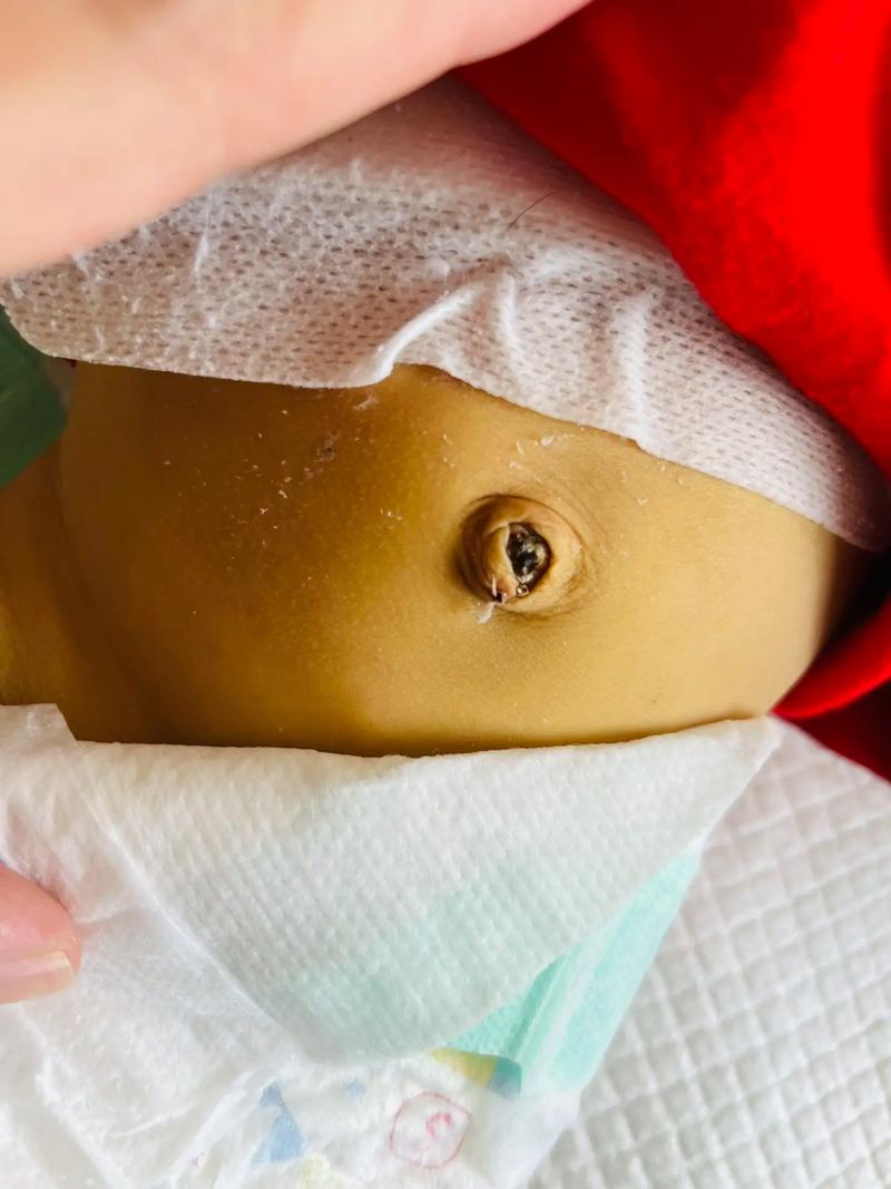 新生儿胆管细窄有哪些典型表现？家长该如何早期识别与应对？-第3张图片-郑州医学网