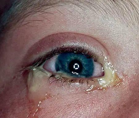 新生儿眼屎多又黄浓，是上火还是眼睛出问题了？-第3张图片-郑州医学网