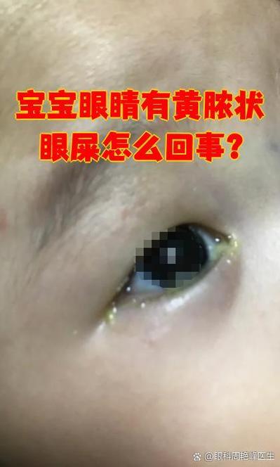 新生儿眼屎多又黄浓，是上火还是眼睛出问题了？-第2张图片-郑州医学网