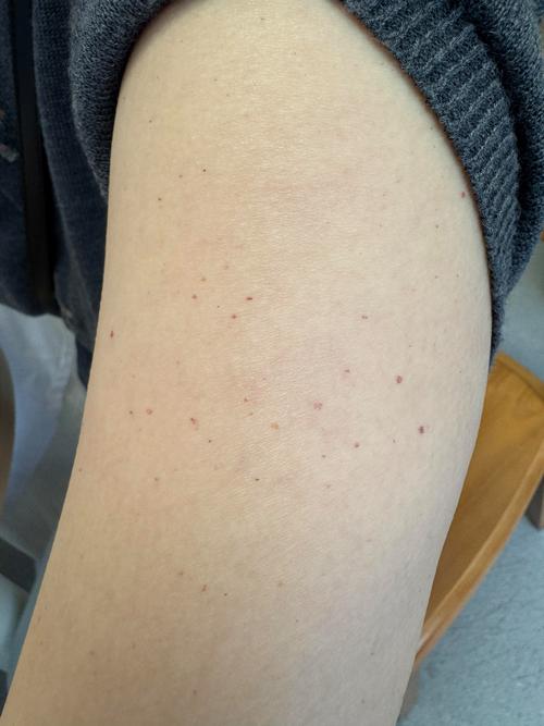 孕期胳膊出现小红点并伴随瘙痒,是哪些原因导致的?需要特别关注吗?-第1张图片-郑州医学网 孕期胳膊出现小红点并伴随瘙痒,是哪些原因导致的?需要特别关注吗?-第1张图片-郑州医学网