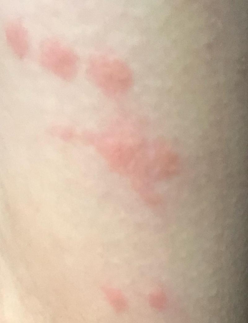 孕期胳膊出现小红点并伴随瘙痒，是哪些原因导致的？需要特别关注吗？-第3张图片-郑州医学网