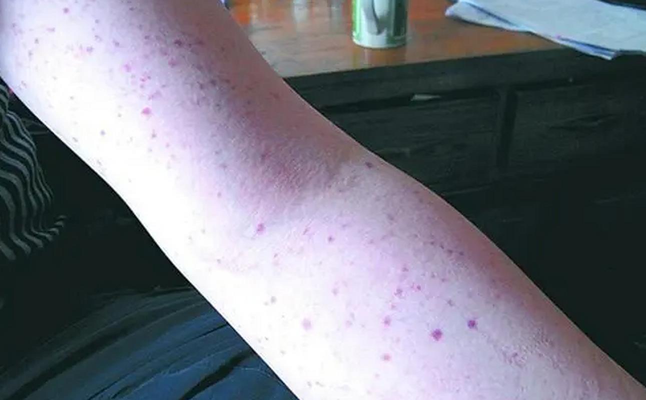 儿童血小板减少性紫癜,病因、症状与治疗全解析,家长需警惕哪些关键问题?-第1张图片-郑州医学网 儿童血小板减少性紫癜,病因、症状与治疗全解析,家长需警惕哪些关键问题?-第1张图片-郑州医学网