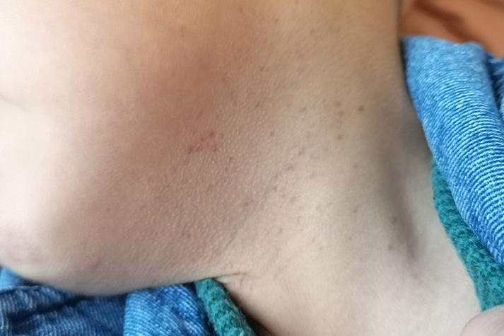 儿童血小板减少性紫癜,病因、症状与治疗全解析,家长需警惕哪些关键问题?-第3张图片-郑州医学网 儿童血小板减少性紫癜,病因、症状与治疗全解析,家长需警惕哪些关键问题?-第3张图片-郑州医学网