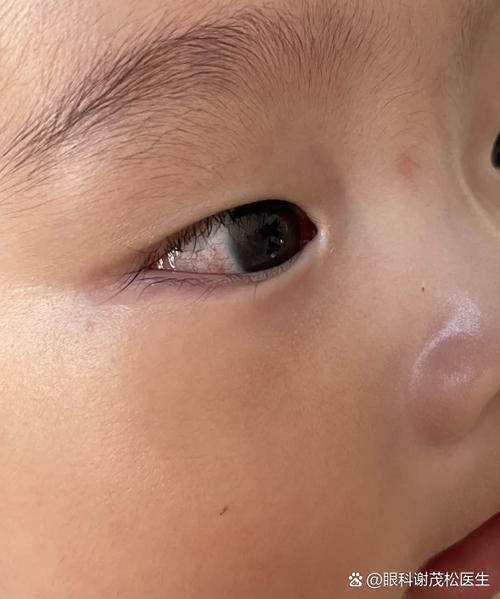 新生儿眼睛看不见有哪些具体症状?家长该如何早期识别与应对?-第1张图片-郑州医学网 新生儿眼睛看不见有哪些具体症状?家长该如何早期识别与应对?-第1张图片-郑州医学网