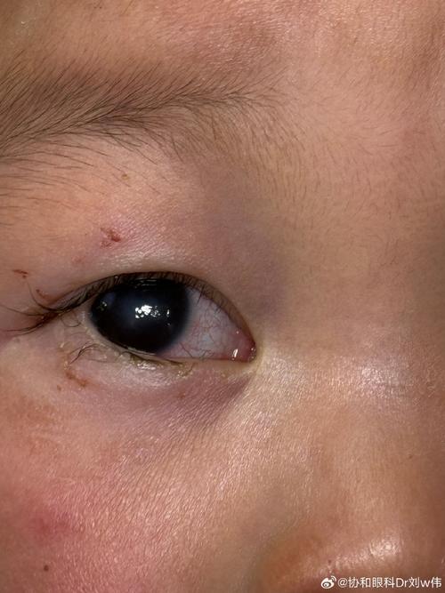 新生儿眼睛看不见有哪些具体症状？家长该如何早期识别与应对？-第2张图片-郑州医学网