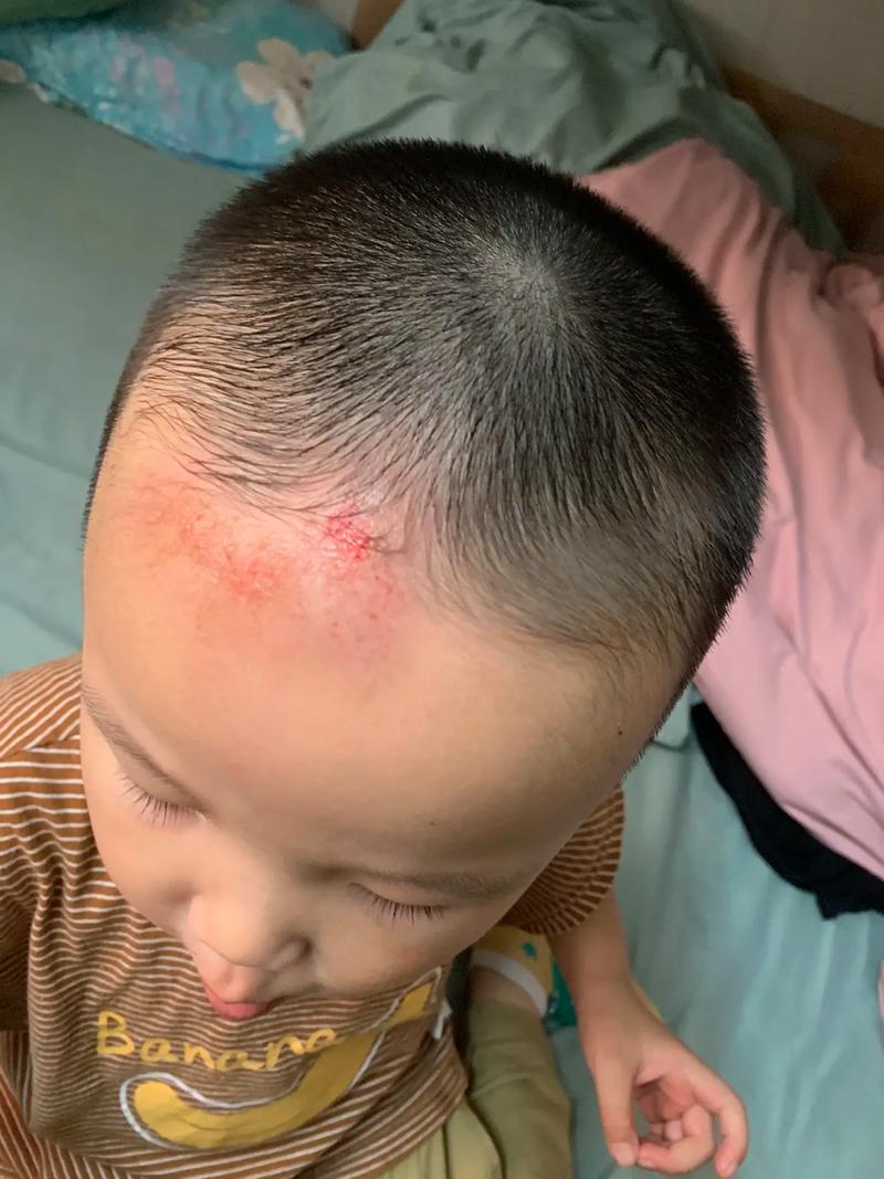 不小心碰到新生儿头部后，家长该如何判断和处理才安全？-第3张图片-郑州医学网