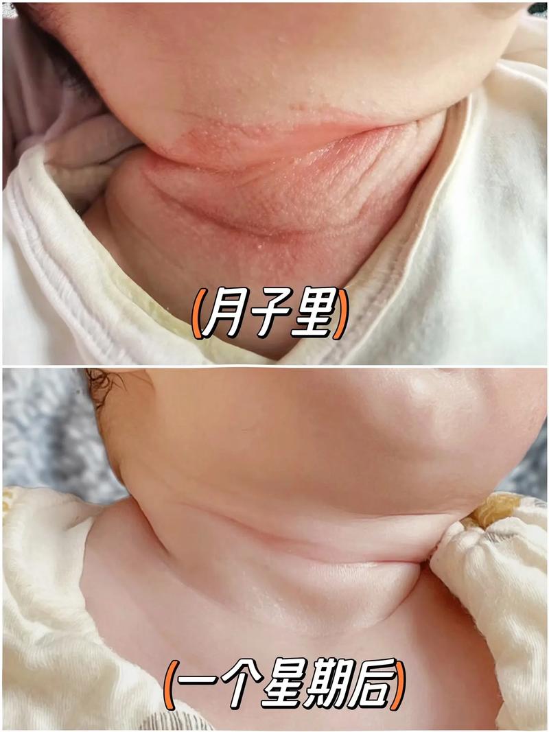 新生儿脖子肉多双下巴是正常现象吗？需要干预吗？-第3张图片-郑州医学网