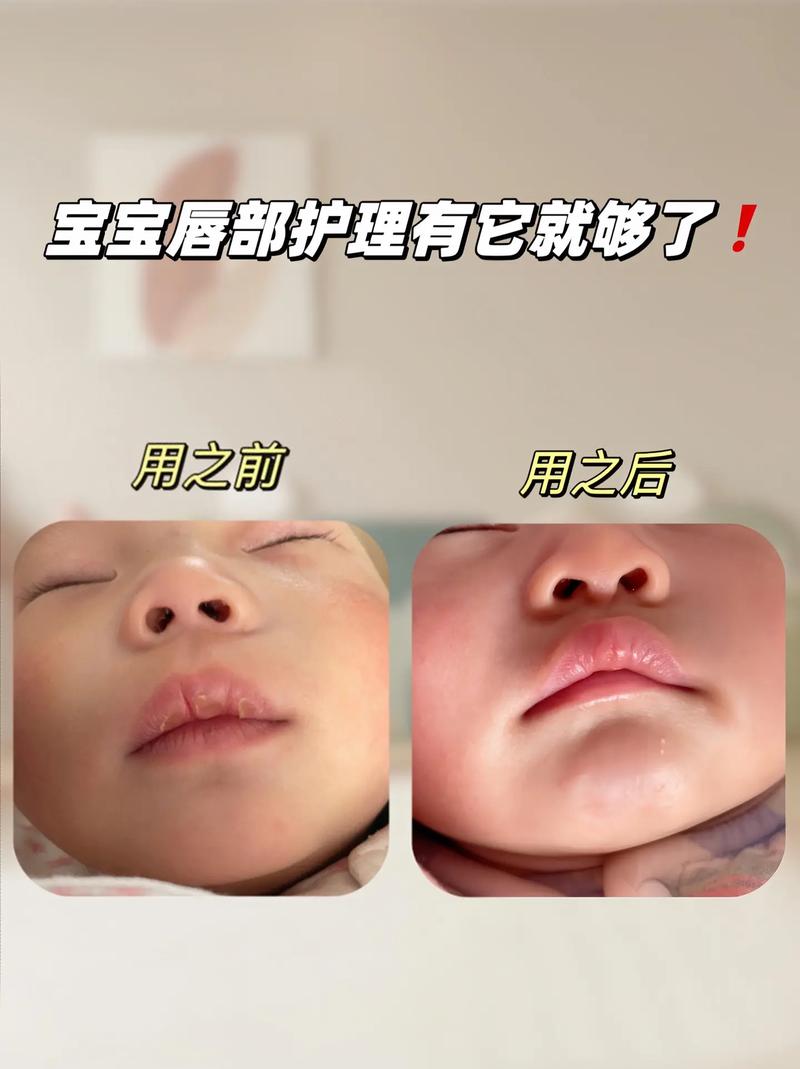 新生儿嘴唇干裂是缺水还是生病了？需要紧急处理吗？-第2张图片-郑州医学网