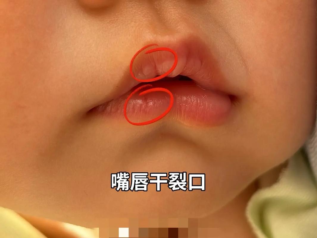 新生儿嘴唇干裂是缺水还是生病了？需要紧急处理吗？-第1张图片-郑州医学网