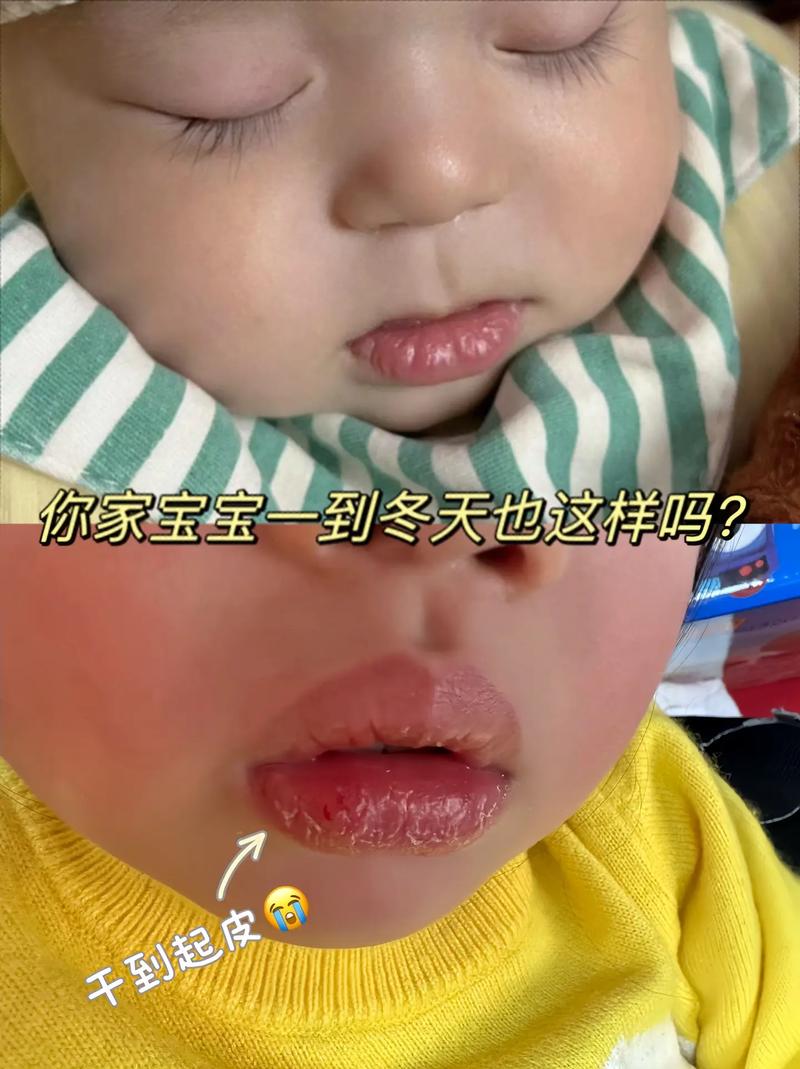 新生儿嘴唇干裂是缺水还是生病了？需要紧急处理吗？-第3张图片-郑州医学网