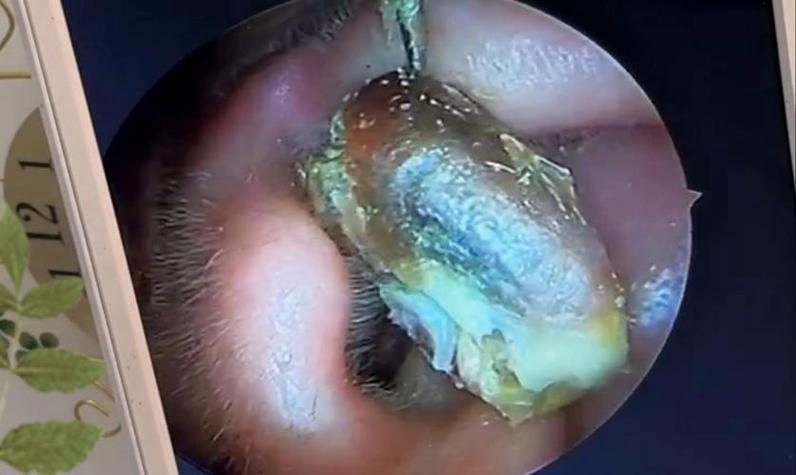 新生儿耳廓里的黏耳屎是正常现象吗？需要清理吗？-第3张图片-郑州医学网