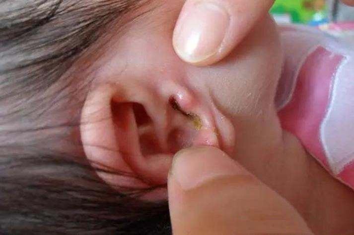 新生儿耳廓里的黏耳屎是正常现象吗？需要清理吗？-第2张图片-郑州医学网