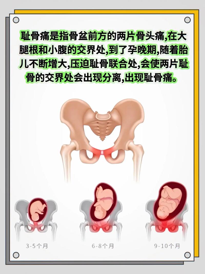孕期耻骨疼是正常生理反应还是疾病信号？原因有哪些，如何缓解？-第1张图片-郑州医学网