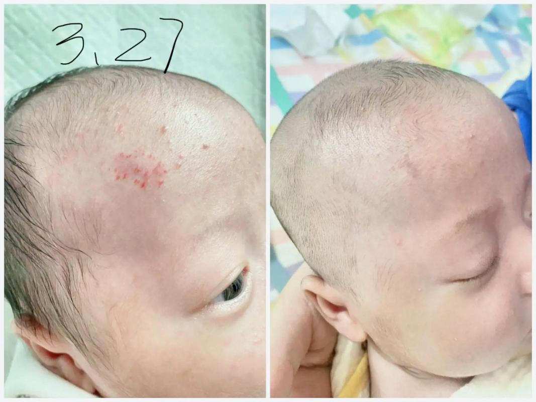 新生儿鼻孔血管瘤图片长什么样？需要警惕哪些特征？-第1张图片-郑州医学网