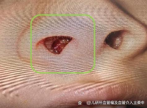 新生儿鼻孔血管瘤图片长什么样？需要警惕哪些特征？-第3张图片-郑州医学网