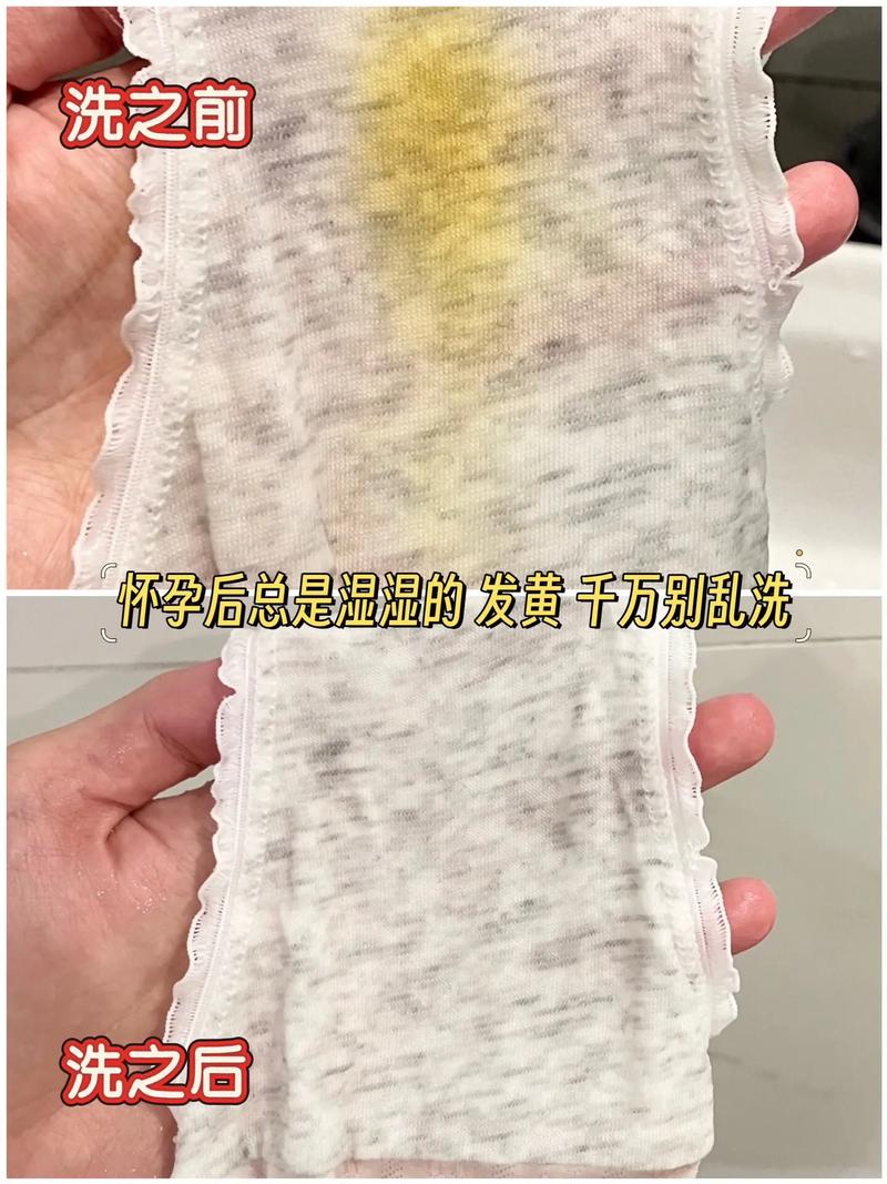 孕期白带有异味是正常现象吗?需要警惕哪些潜在问题?-第3张图片-郑州医学网 孕期白带有异味是正常现象吗?需要警惕哪些潜在问题?-第3张图片-郑州医学网