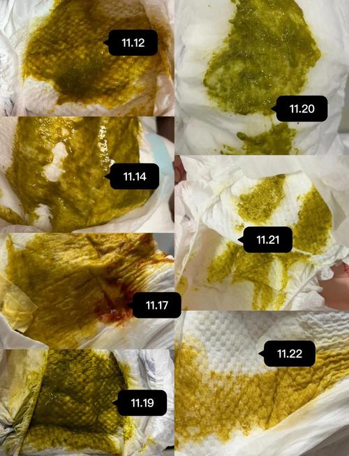 新生儿拉肚子大便图能准确区分生理性腹泻与病理性腹泻吗？-第2张图片-郑州医学网