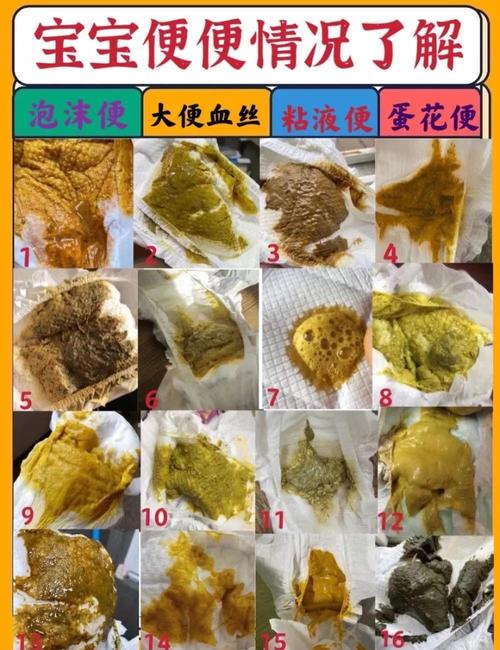 新生儿拉肚子大便图能准确区分生理性腹泻与病理性腹泻吗？-第1张图片-郑州医学网