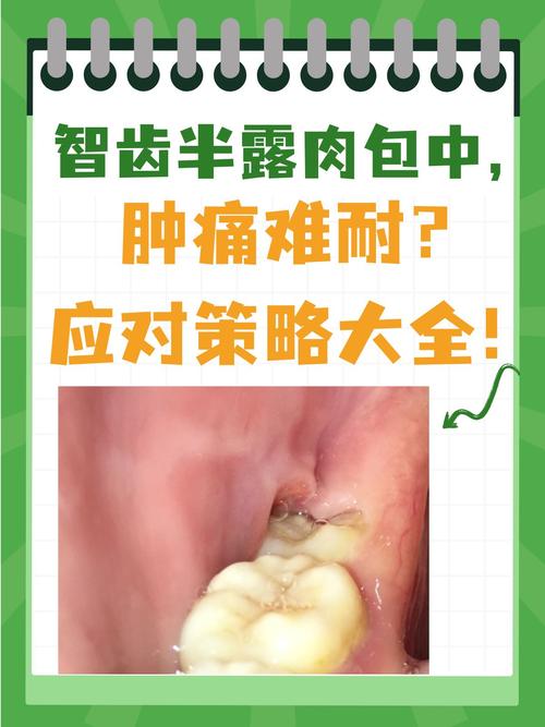 孕期智齿冠周炎疼得睡不着，不治疗会影响胎儿吗？-第2张图片-郑州医学网