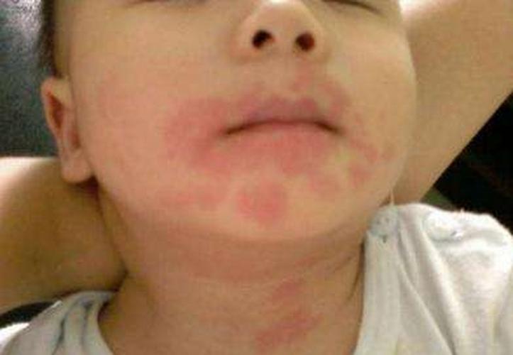 儿童吃芒果过敏后该如何正确处理，日常又该如何预防？-第3张图片-郑州医学网