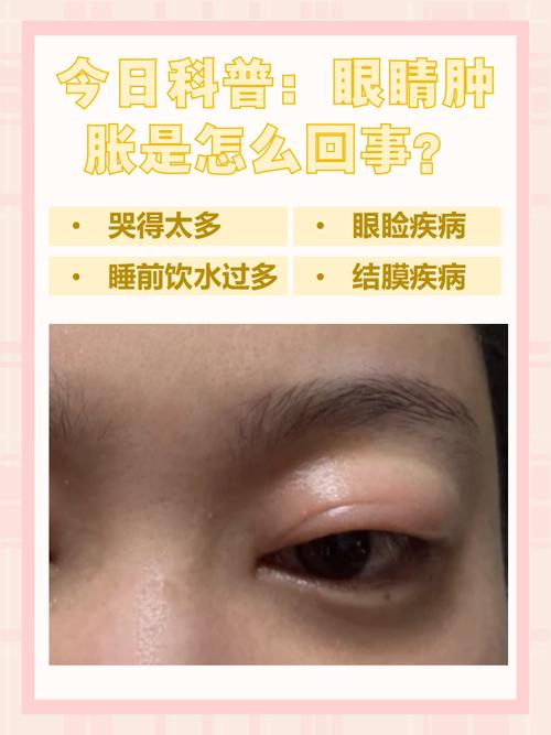 儿童眼睛肿是什么原因?是过敏、感染还是其他健康问题在作祟?-第3张图片-郑州医学网 儿童眼睛肿是什么原因?是过敏、感染还是其他健康问题在作祟?-第3张图片-郑州医学网